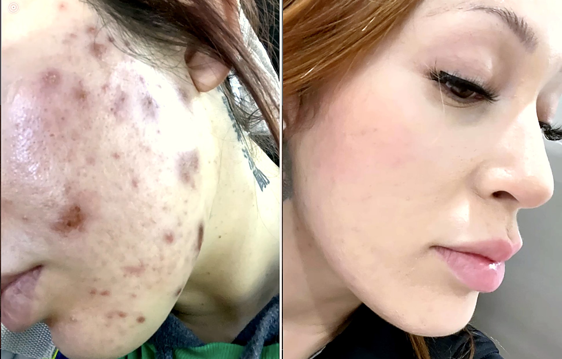 Antes y después acné