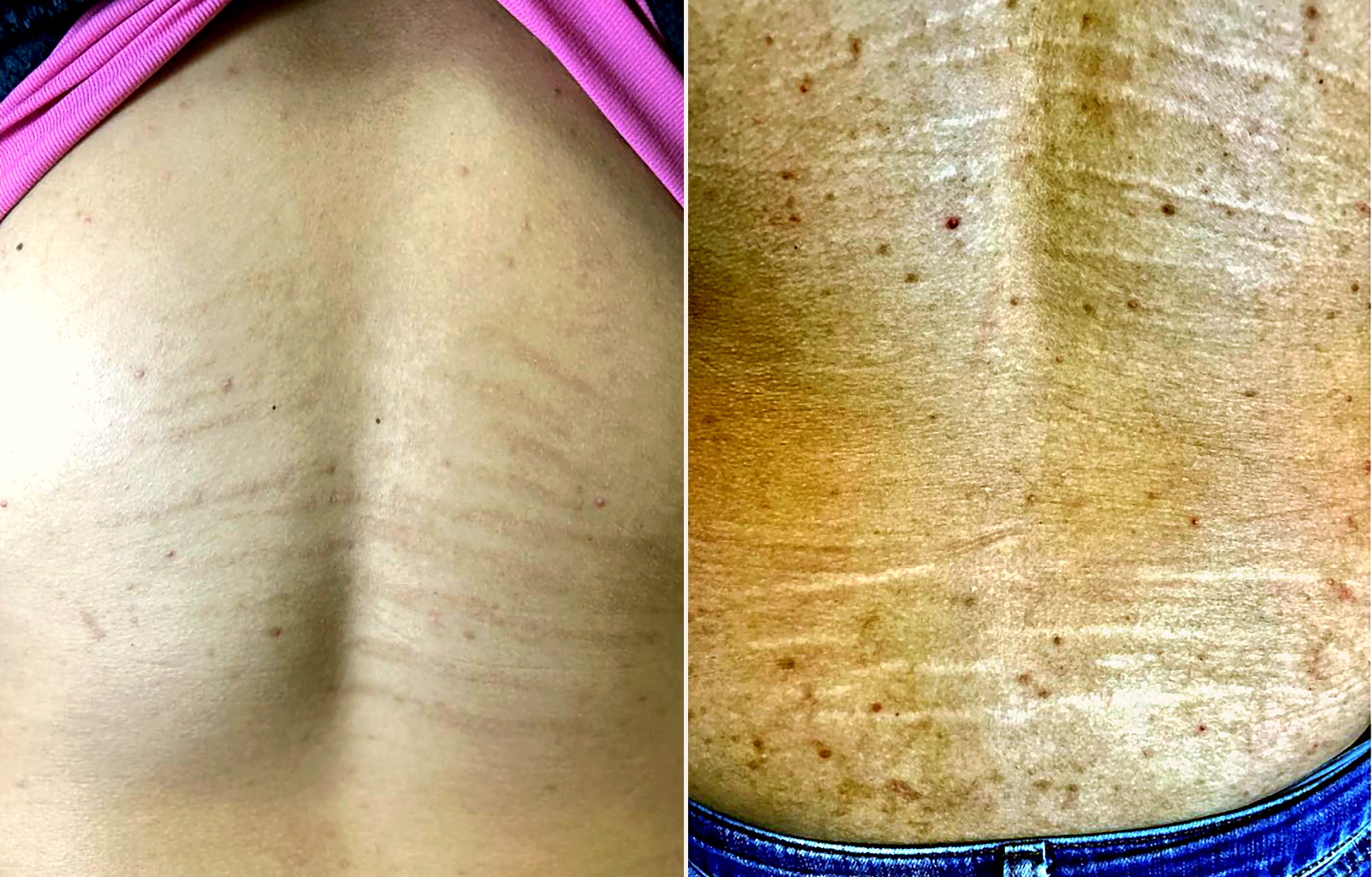 Antes y después corporal
