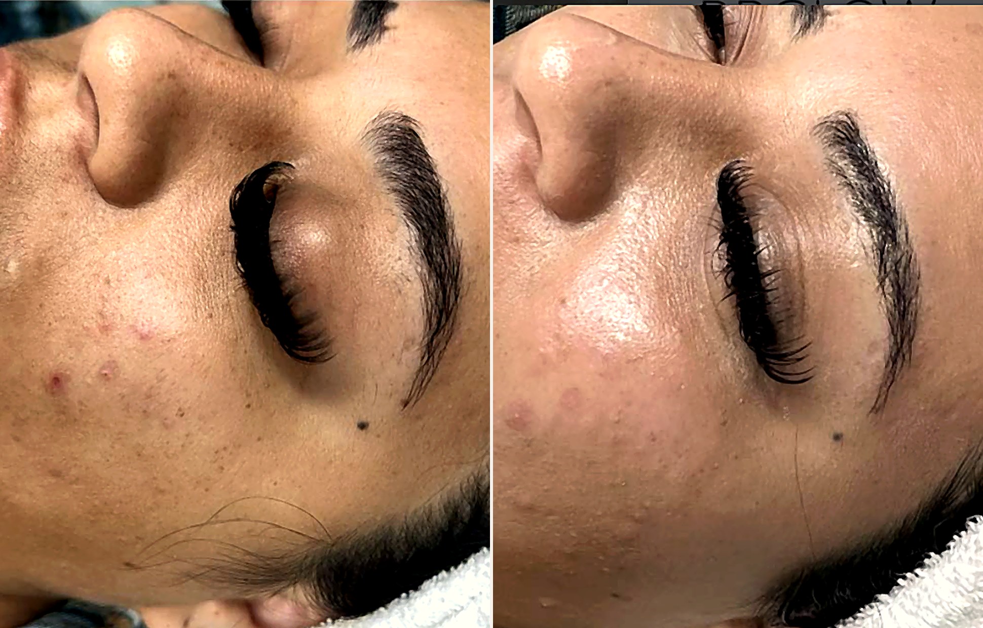 Antes y después facial