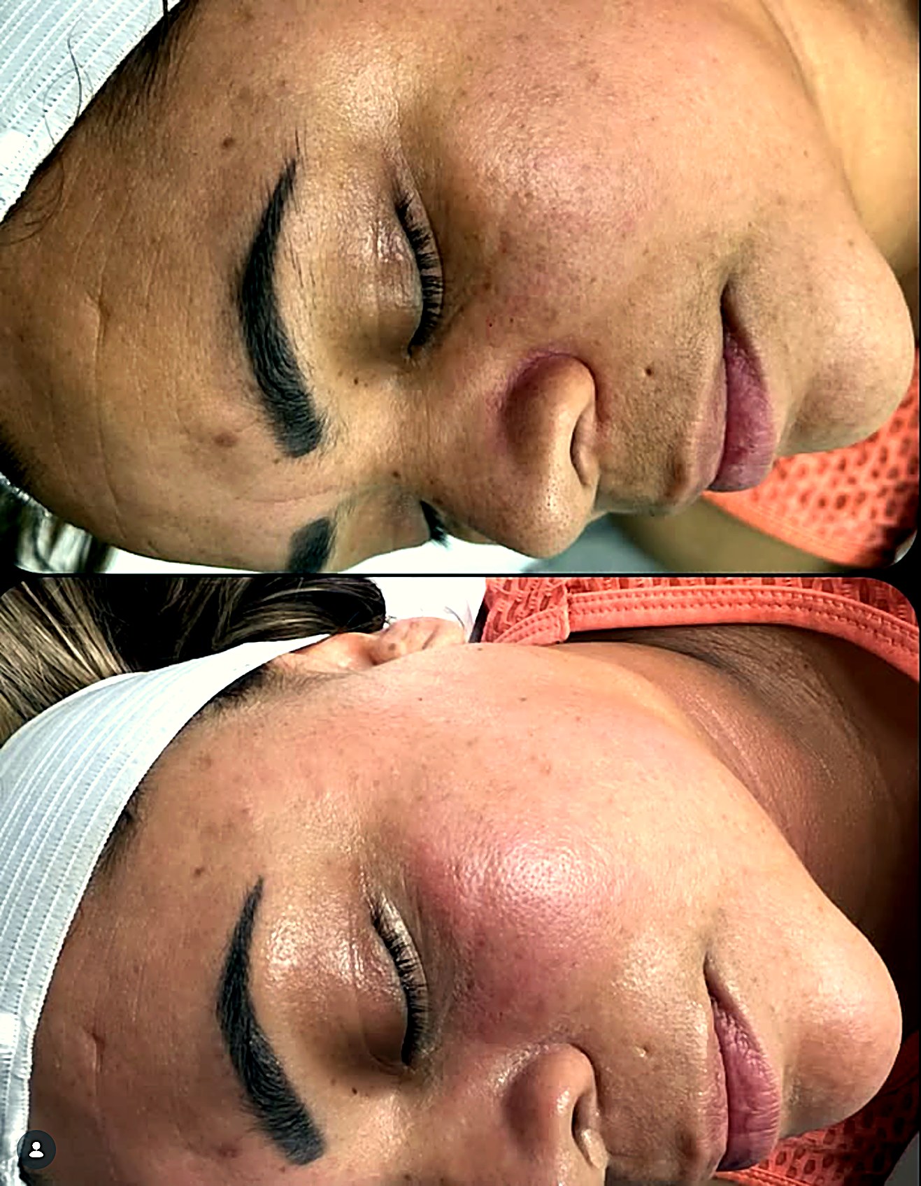 Antes y después facial