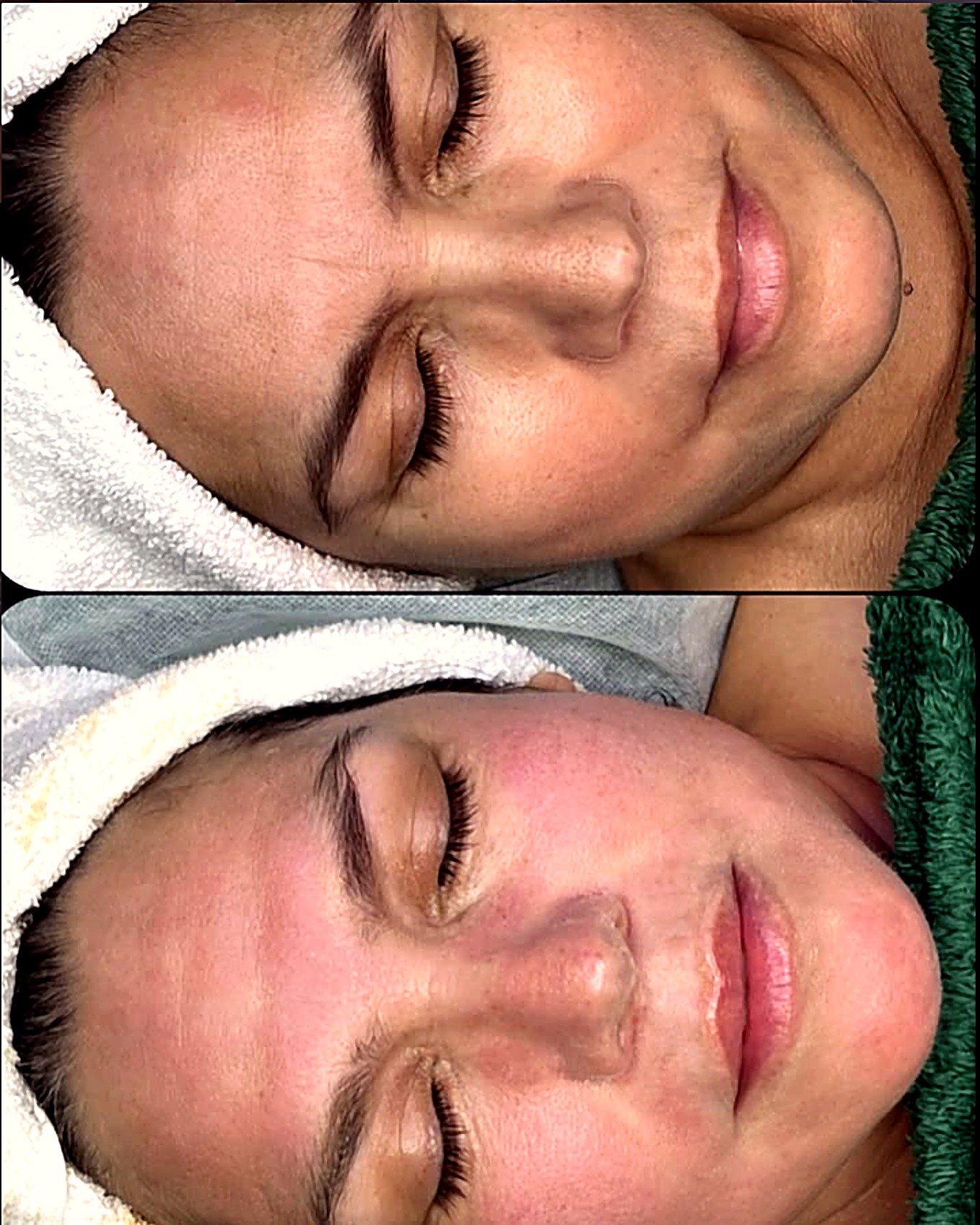 Antes y después facial
