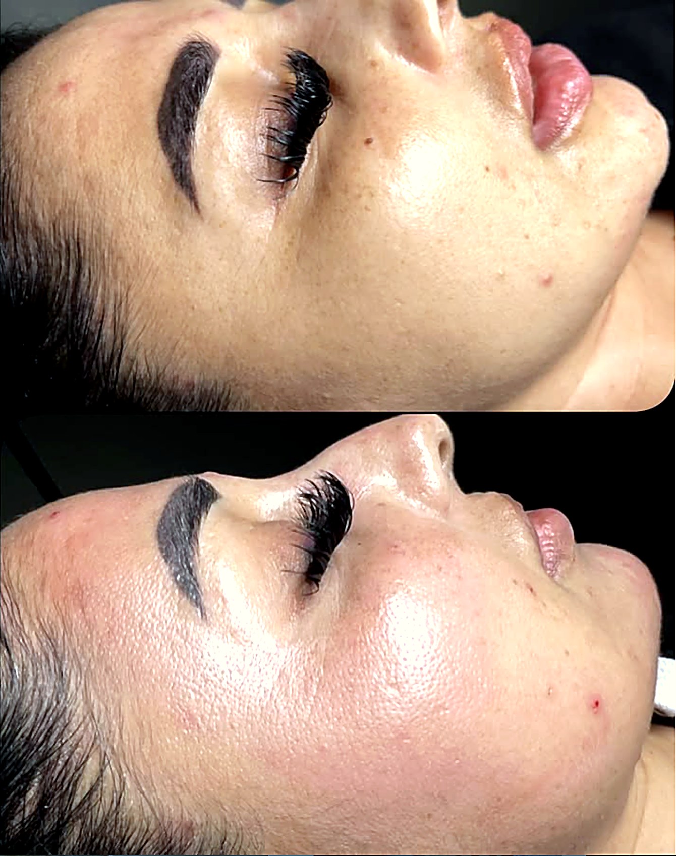 Antes y después facial